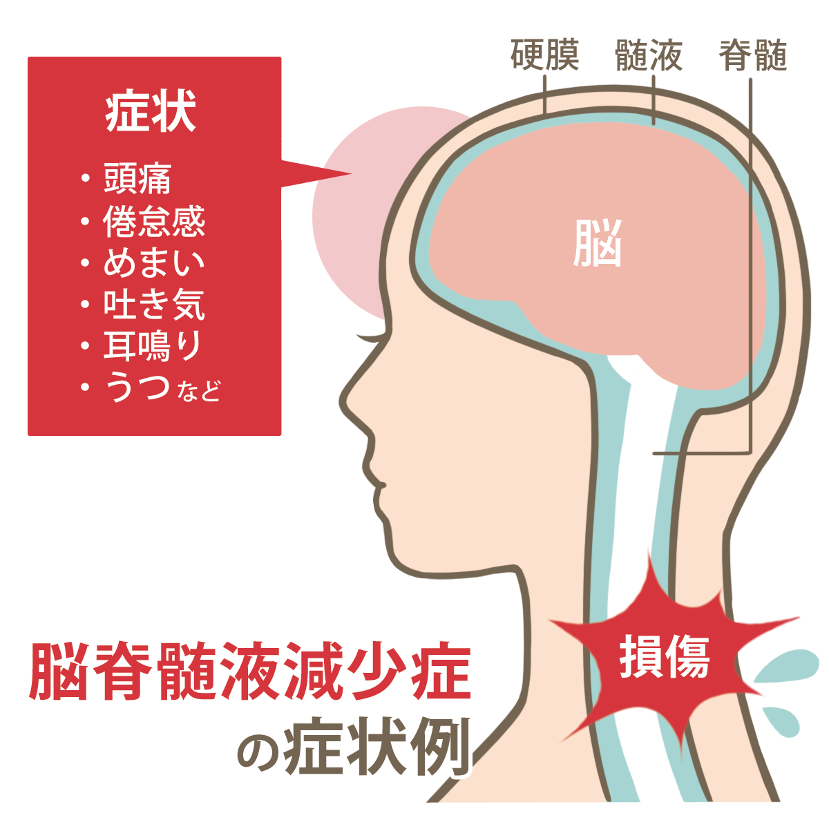 脳脊髄液減少症イラスト